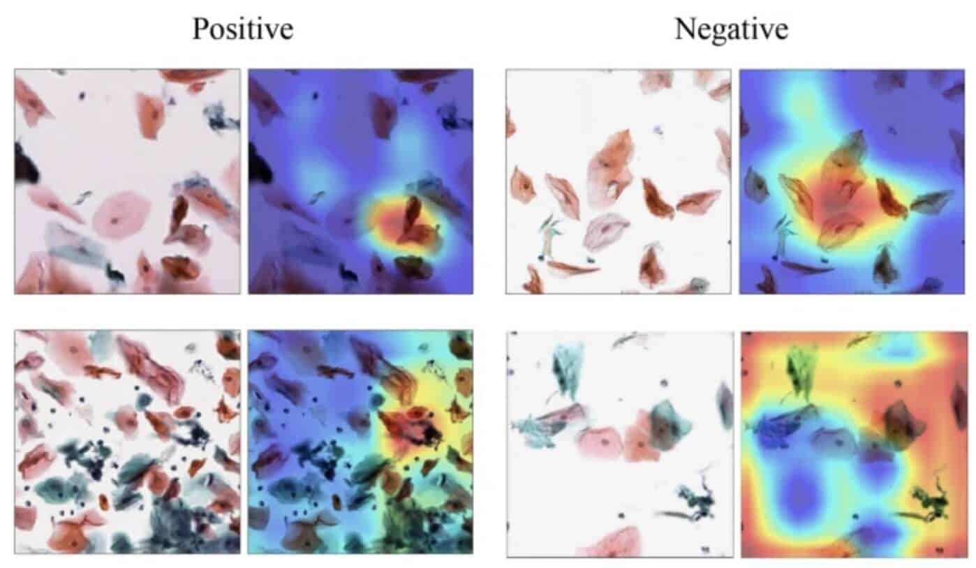 Sukegawa, Shintaro, Tanaka, Futa, Nakano, Keisuke, Hara, Takeshi, Yoshii, Kazumasa, Yamashita, Katsusuke, Furuki, Yoshihiko, Effective deep learning for oral exfoliative cytology classification. Scientific Reports, 12(1), 13281. doi:10.1038/s41598-022-17602-4
