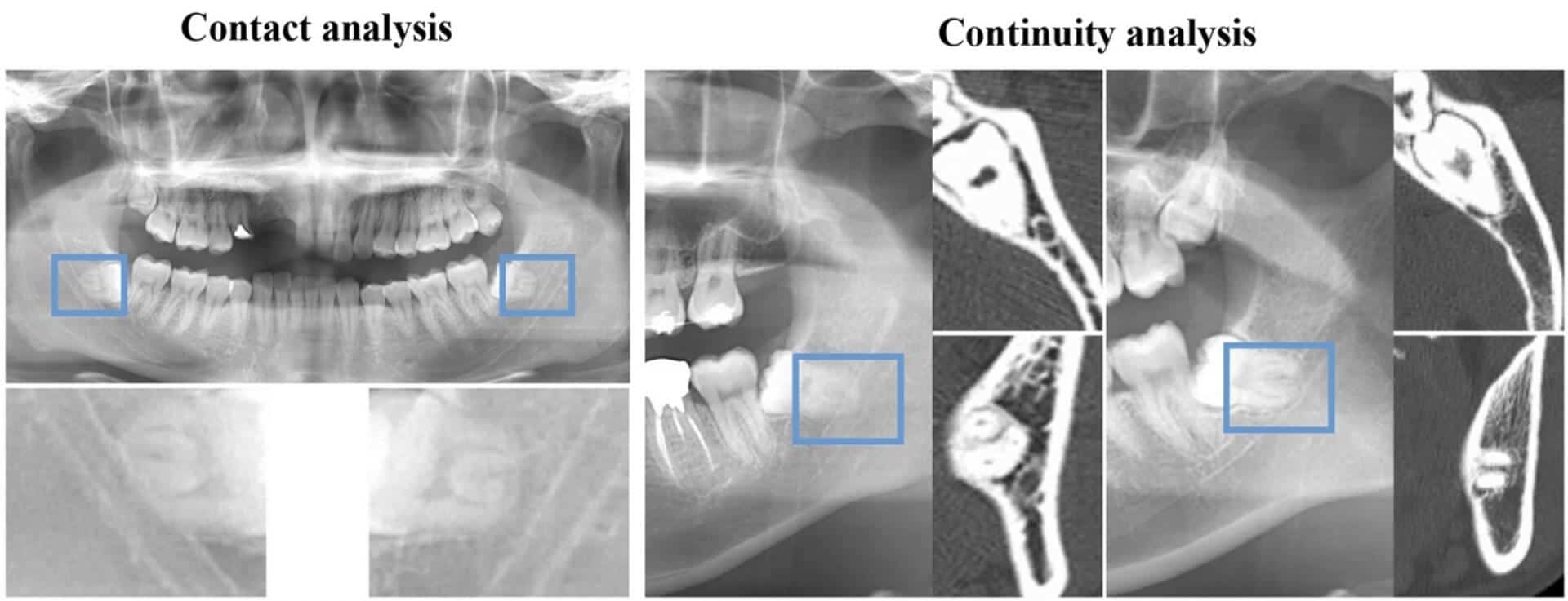 Sukegawa S, Tanaka F, Hara, T, et al. Deep learning model for analyzing the relationship between mandibular third molar and inferior alveolar nerve in panoramic radiography. Scientific Reports, 2022.